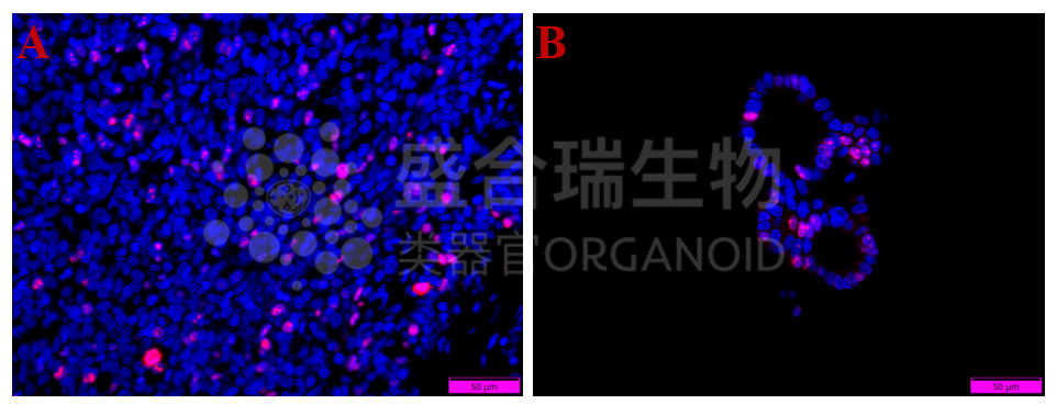 食管鳞癌类器官Ki67免疫荧光染色